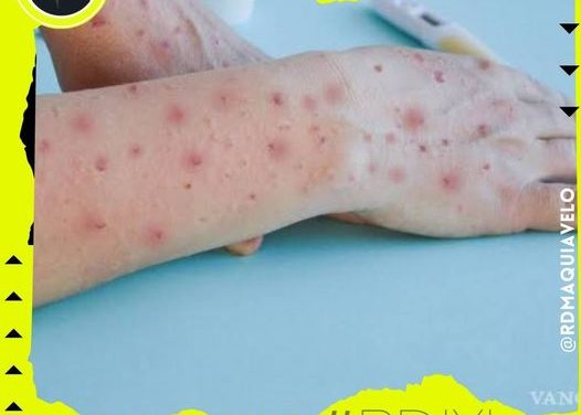 REPORTAN 19 CASOS DE VIRUELA DEL MONO EN NUEVO LEÓN