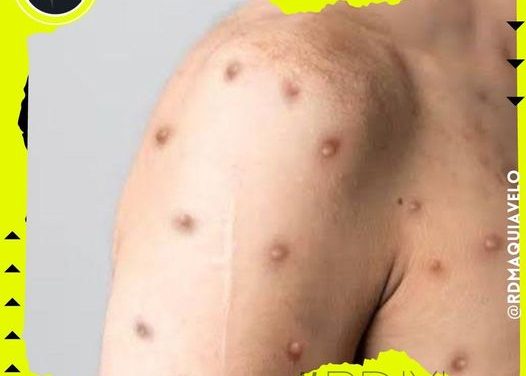 REPORTA MÉXICO 186 CASOS NUEVOS DE VIRUELA DEL MONO EN LA ÚLTIMA SEMANA