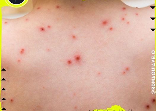 REGISTRA MÉXICO 3,007 CASOS DE VIRUELA DEL MONO, 7 PERSONAS HAN PERDIDO LA VIDA A CAUSA DEL VIRUS