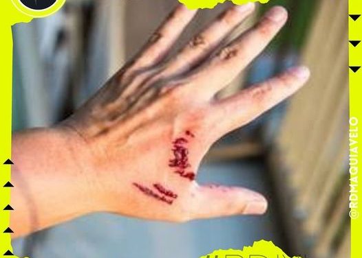 INFORMA SECRETARÍA DE SALUD ACERCA DE TRES CASOS DE RABIA EN NIÑOS EN OAXACA