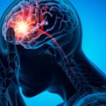 PREOCUPA AUMENTO DE INFARTOS CEREBRALES EN MENORES DE 45 AÑOS