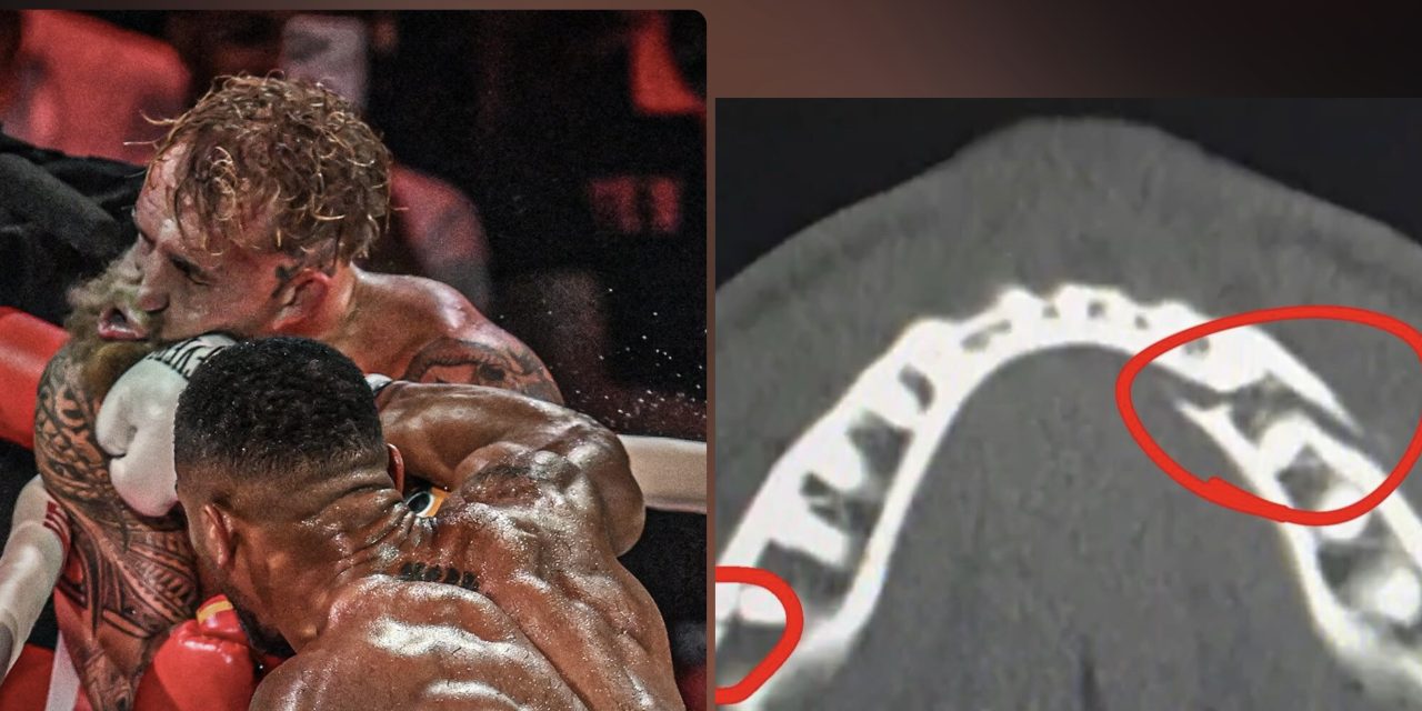 JAKE PAUL TERMINA CON DOBLE FRACTURA DE MANDÍBULA LUEGO DE CAER ANTE ANTHONY JOSHUA