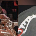 JAKE PAUL TERMINA CON DOBLE FRACTURA DE MANDÍBULA LUEGO DE CAER ANTE ANTHONY JOSHUA