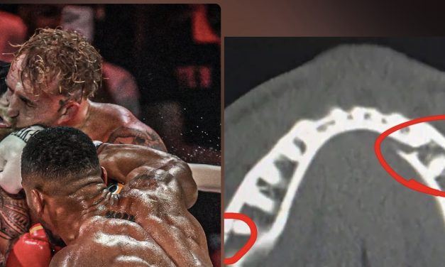 JAKE PAUL TERMINA CON DOBLE FRACTURA DE MANDÍBULA LUEGO DE CAER ANTE ANTHONY JOSHUA
