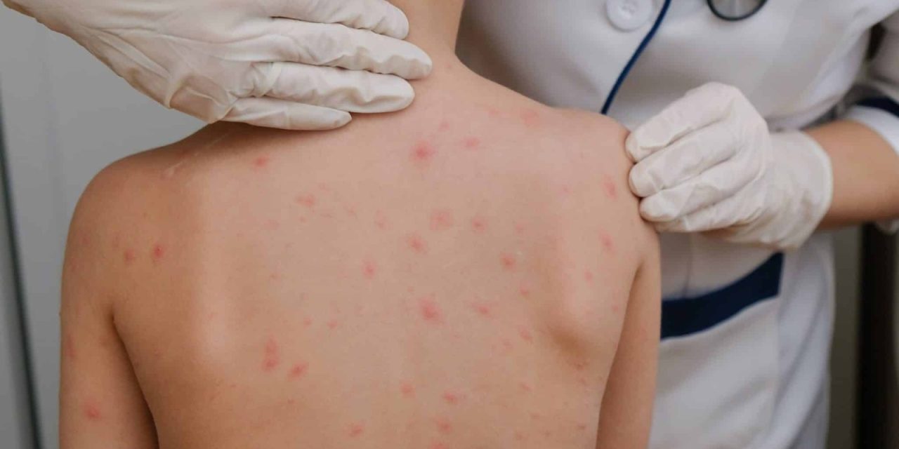 JUÁREZ Y GARCÍA LIDERAN LOS CONTAGIOS DE SARAMPIÓN EN NUEVO LEÓN, REPORTA LA SECRETARÍA DE SALUD