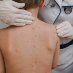 JUÁREZ Y GARCÍA LIDERAN LOS CONTAGIOS DE SARAMPIÓN EN NUEVO LEÓN, REPORTA LA SECRETARÍA DE SALUD