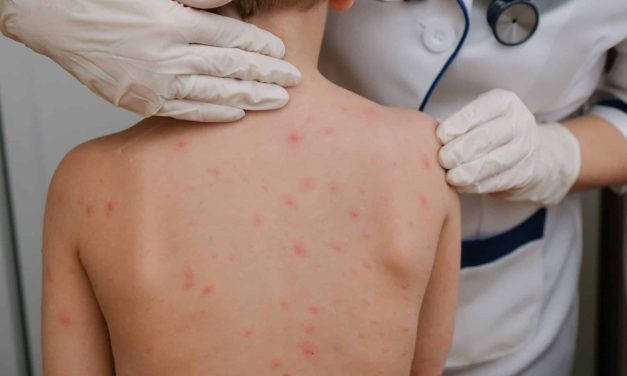 JUÁREZ Y GARCÍA LIDERAN LOS CONTAGIOS DE SARAMPIÓN EN NUEVO LEÓN, REPORTA LA SECRETARÍA DE SALUD