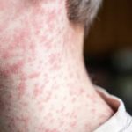 SECRETARÍA DE SALUD MANTIENE CONTROL Y VIGILANCIA ACTIVA ANTE CASOS DE SARAMPIÓN EN NUEVO LEÓN