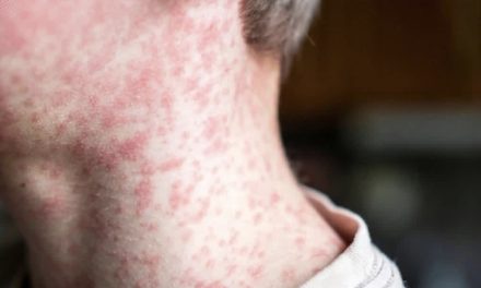 SECRETARÍA DE SALUD MANTIENE CONTROL Y VIGILANCIA ACTIVA ANTE CASOS DE SARAMPIÓN EN NUEVO LEÓN