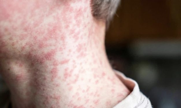 SECRETARÍA DE SALUD MANTIENE CONTROL Y VIGILANCIA ACTIVA ANTE CASOS DE SARAMPIÓN EN NUEVO LEÓN