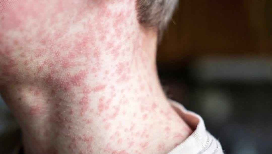 SECRETARÍA DE SALUD MANTIENE CONTROL Y VIGILANCIA ACTIVA ANTE CASOS DE SARAMPIÓN EN NUEVO LEÓN