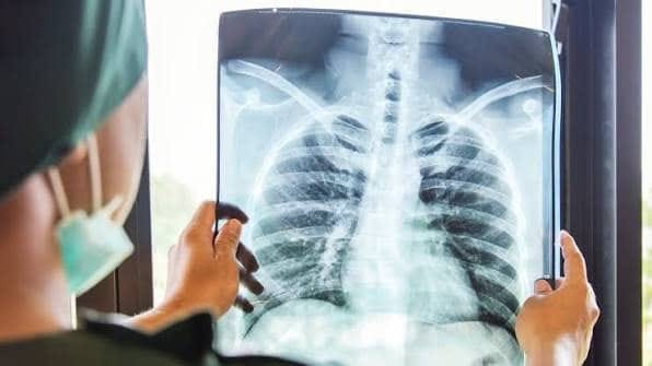 ALMA ROSA MARROQUÍN IMPULSA DETECCIÓN TEMPRANA DEL CÁNCER DE PULMÓN CON INTELIGENCIA ARTIFICIAL